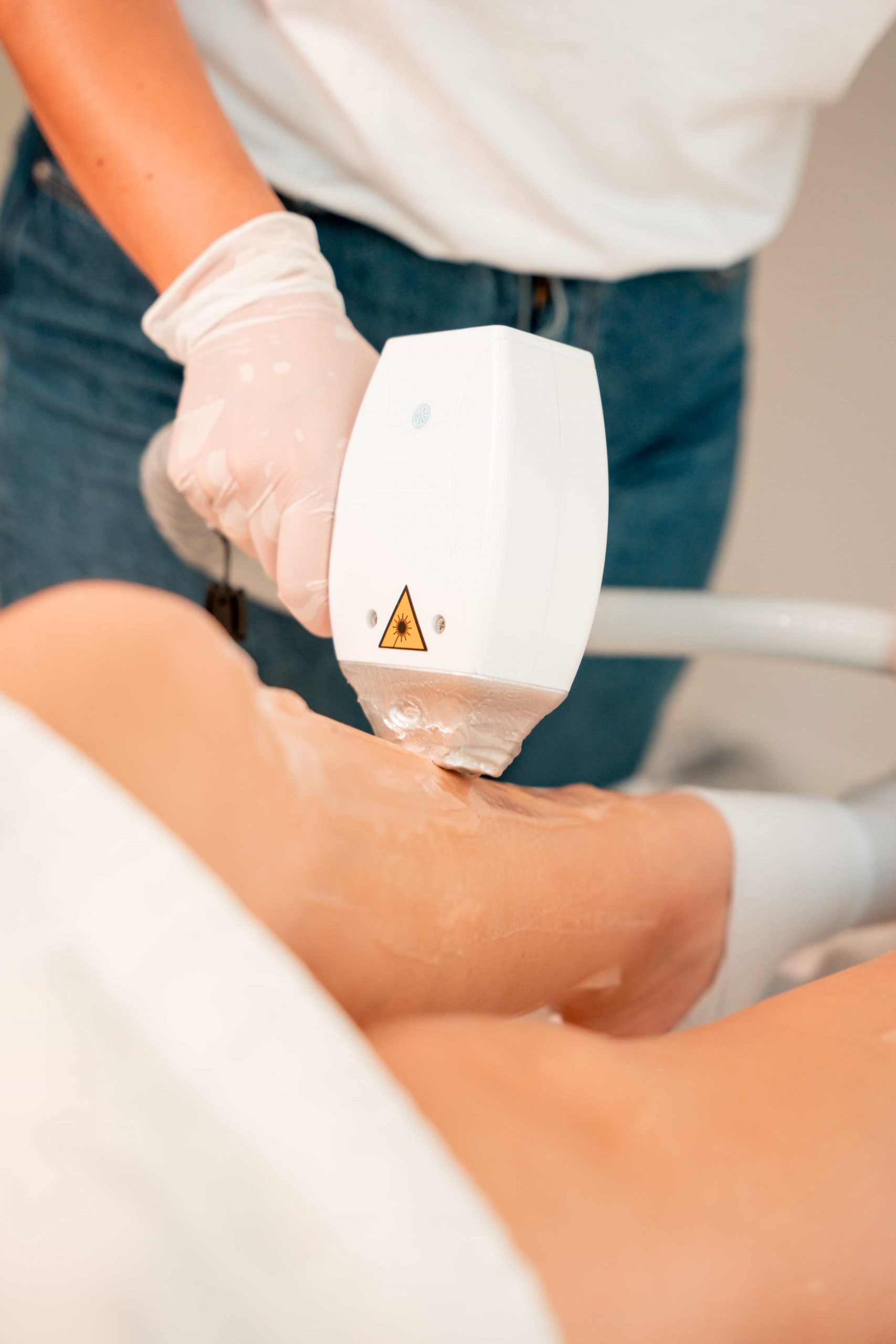 Beine werden behandelt. Dauerhafte Haarentfernung in Obertshausen