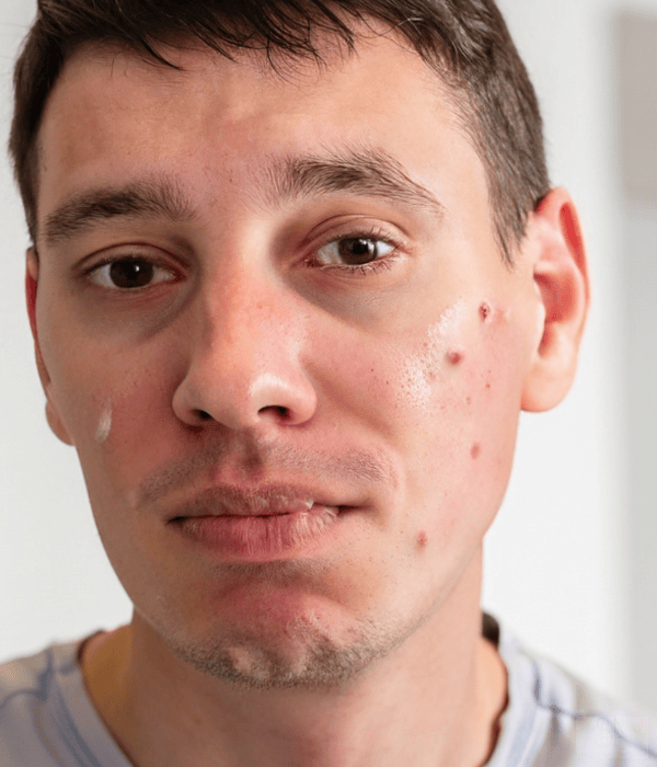 Aknebehandlung für Männer