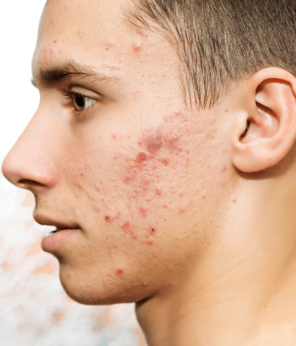 Aknebehandlung für Männer