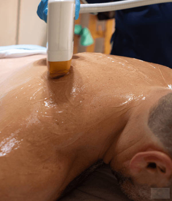 Rückenhaar entfernen in Obertshausen mit Laser